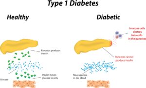 Type_1_diabetes