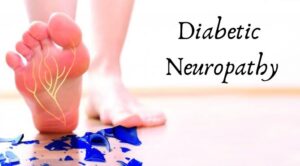 neuropathy