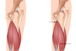 Hamstring-Muscle-Strain_02